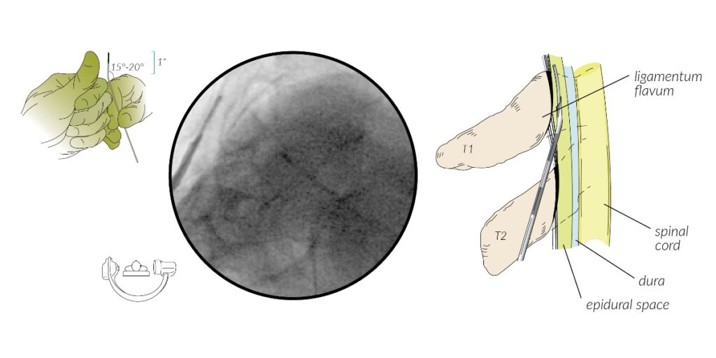 Catheter Placement - Cervical Lysis