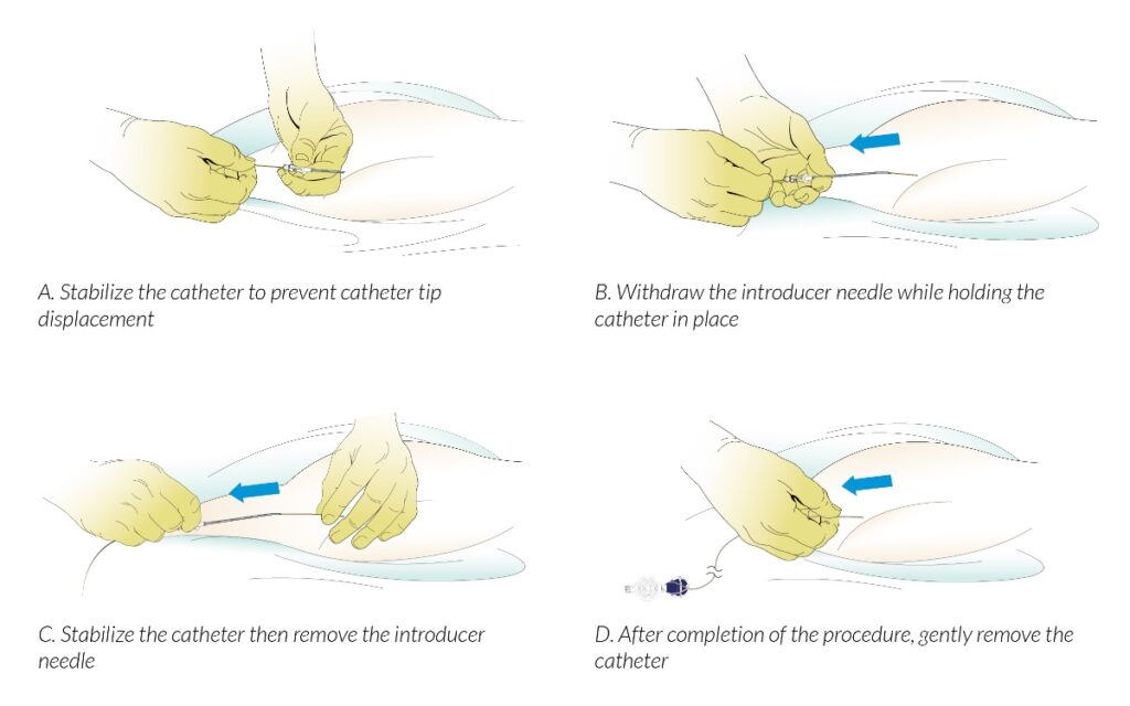 Caudal Lysis - Removal of Needles